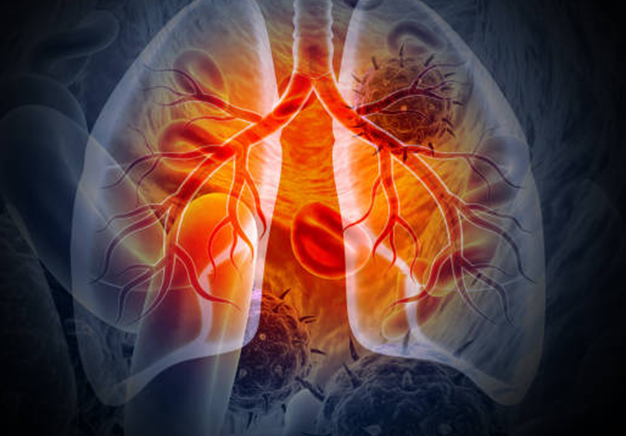 Emerging Biomarkers in Lung Cancer: Beyond EGFR and ALK